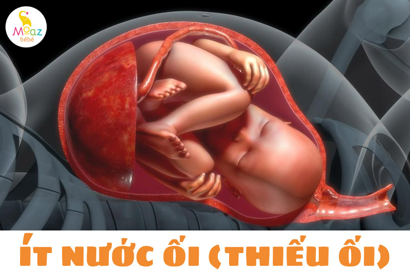 Ít nước ối là gì?