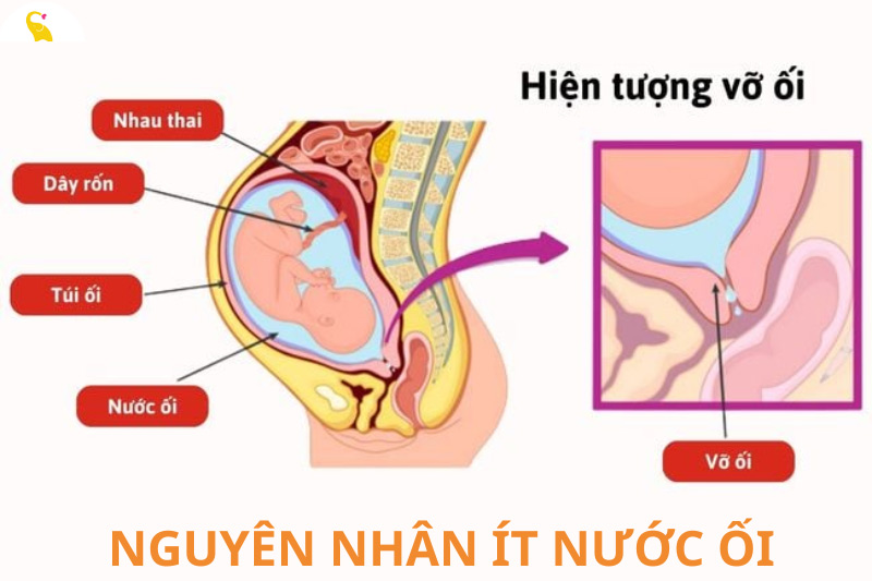 Nguyên nhân gây ra tình trạng ít nước ối