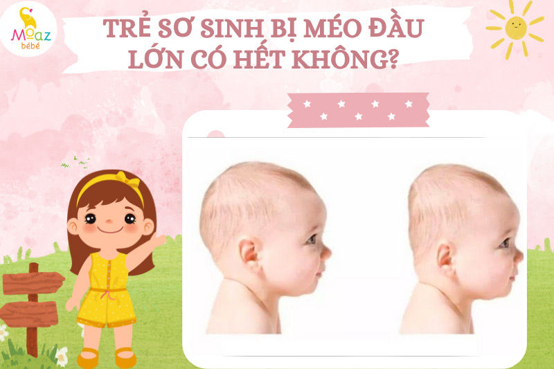 Tại sao trẻ bị méo đầu? 