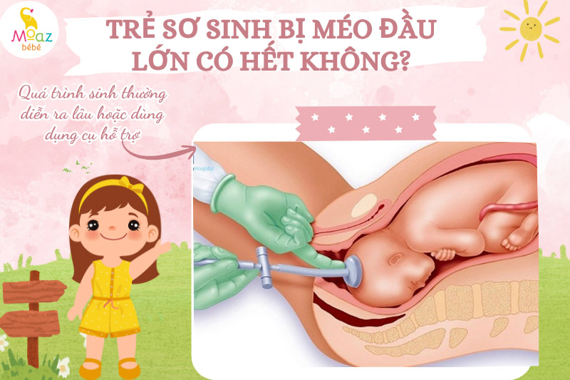 trẻ bị méo đầu do sử dụng dụng cụ trong quá trình sinh