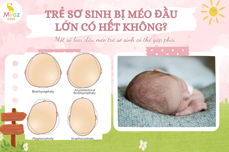 Một số loại đầu méo trẻ sơ sinh có thể gặp phải