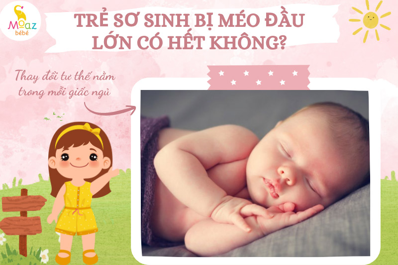 Cách phòng ngừa tình trạng méo đầu ở trẻ