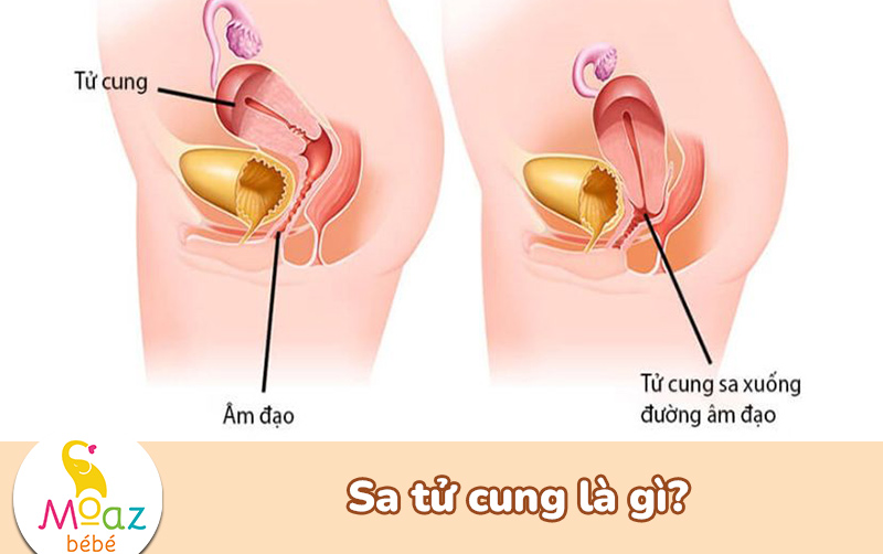 Sa tử cung sau sinh là gì?