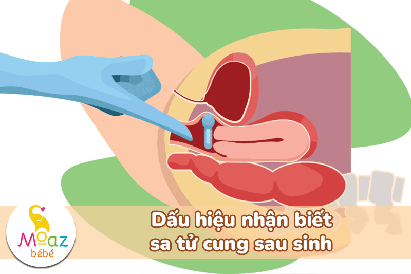 Dấu hiệu nhận biết sa tử cung sau sinh