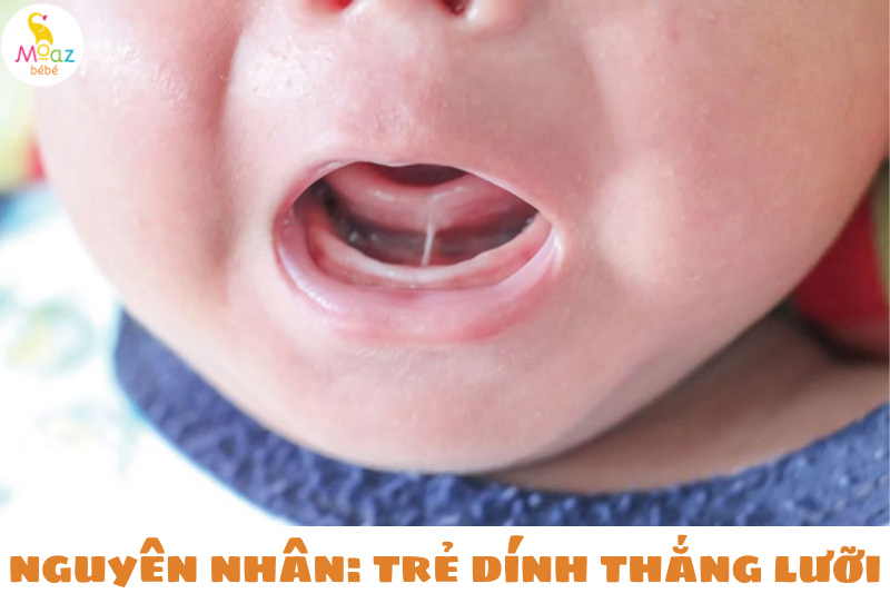 Nguyên nhân khiến trẻ bị dính thắng lưỡi 