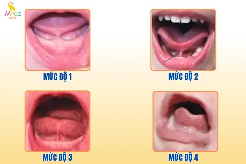 Các mức độ dính thắng lưỡi ở trẻ