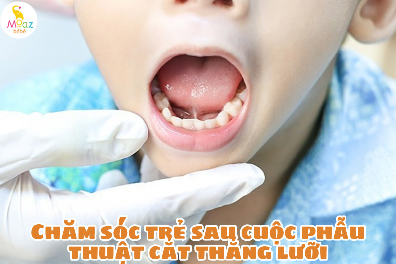 Chăm sóc trẻ sau cuộc phẫu thuật cắt thắng lưỡi