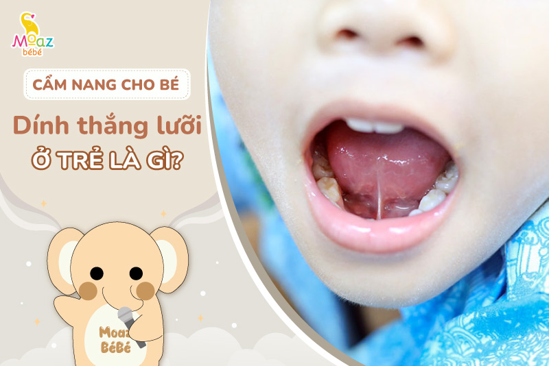 Tật dính thắng lưỡi là gì?