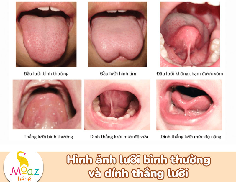 lưỡi bình thường và dính thắng lưỡi