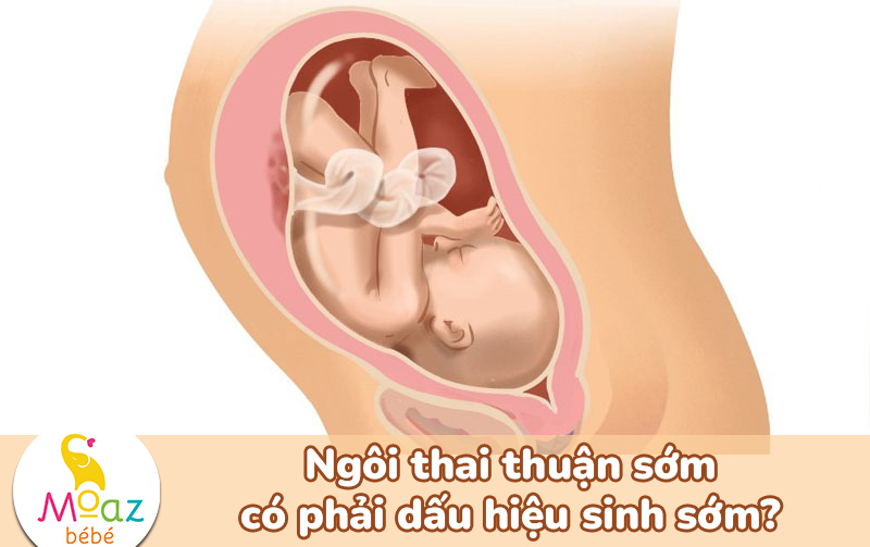 Ngôi thai thuận sớm có phải dấu hiệu sinh sớm?