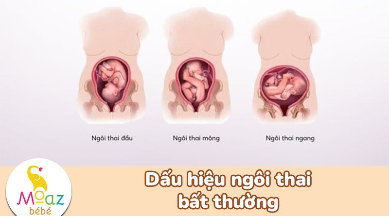 dấu hiệu ngôi thai bất thường