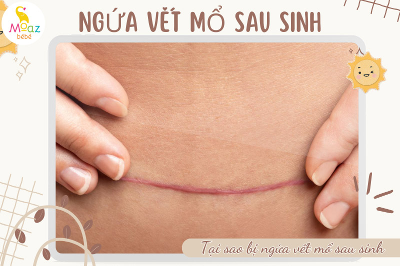 Tại sao mẹ bị ngứa vết mổ sau sinh