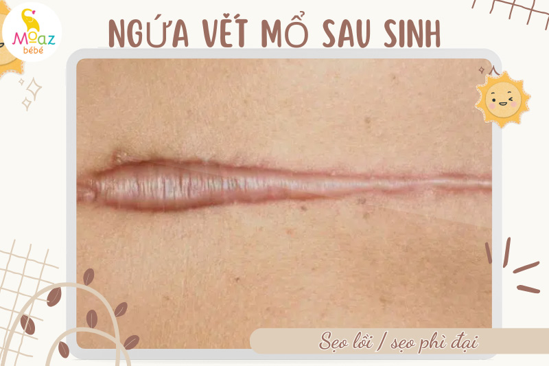 Tại sao mẹ bị ngứa vết mổ sau sinh