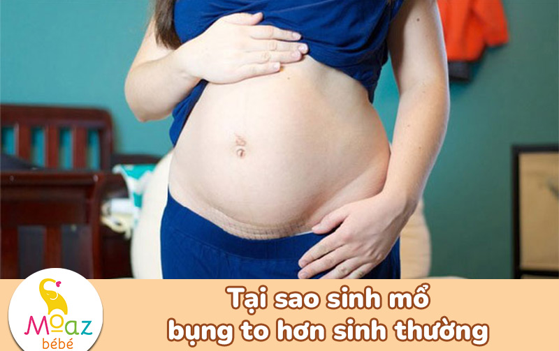 Tại sao sinh mổ bụng to hơn sinh thường?