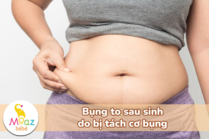 bụng to sau sinh do bị tách cơ bụng