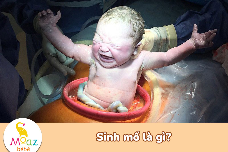 Sinh mổ là gì?