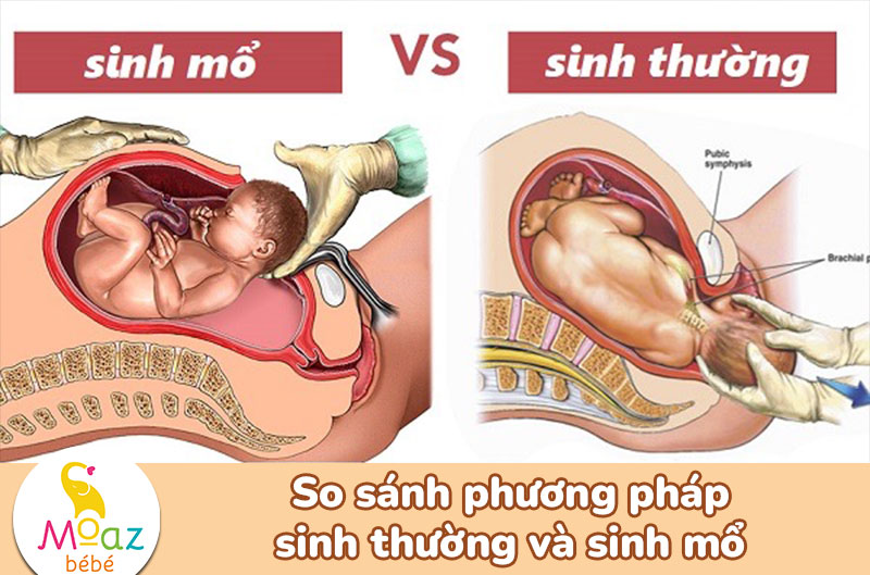 So sánh 2 phương pháp sinh thường và sinh mổ