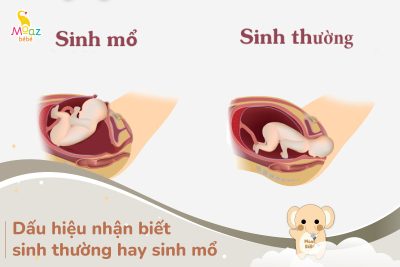 Dấu hiệu nhận biết sinh thường hay sinh mổ