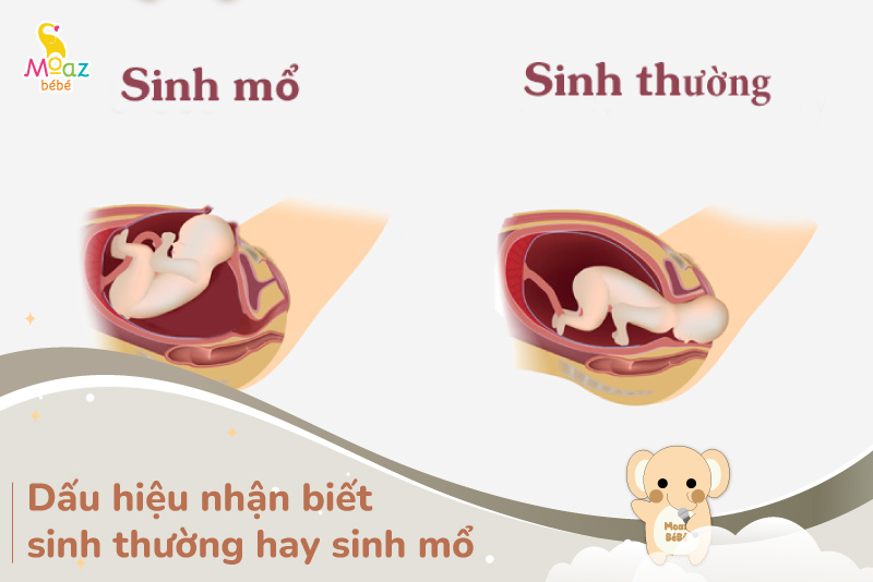 Dấu hiệu nhận biết sinh thường hay sinh mổ