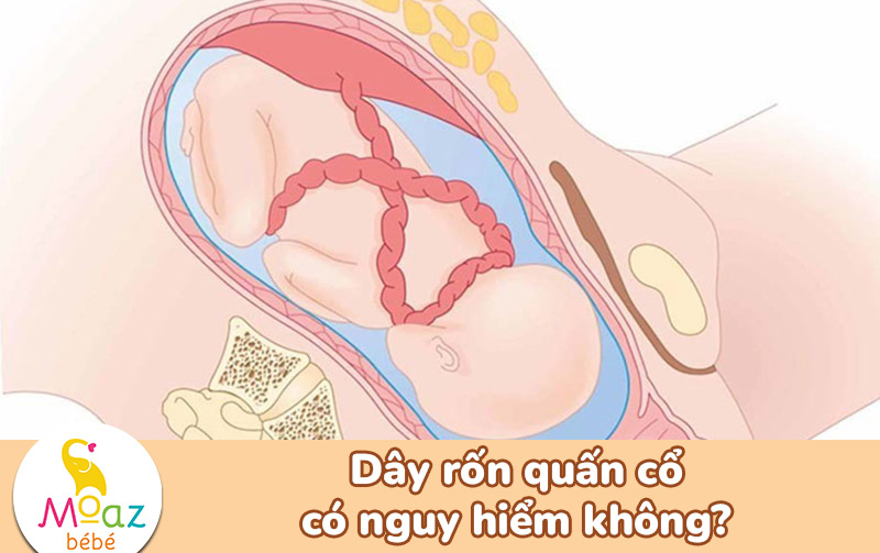 dây rốn quấn cổ có nguy hiểm không