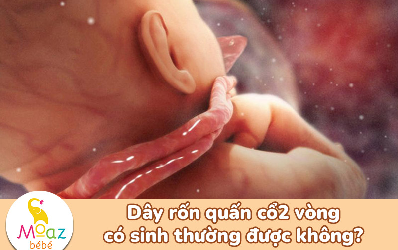 Dây rốn quấn cổ 2 vòng sinh thường được không?
