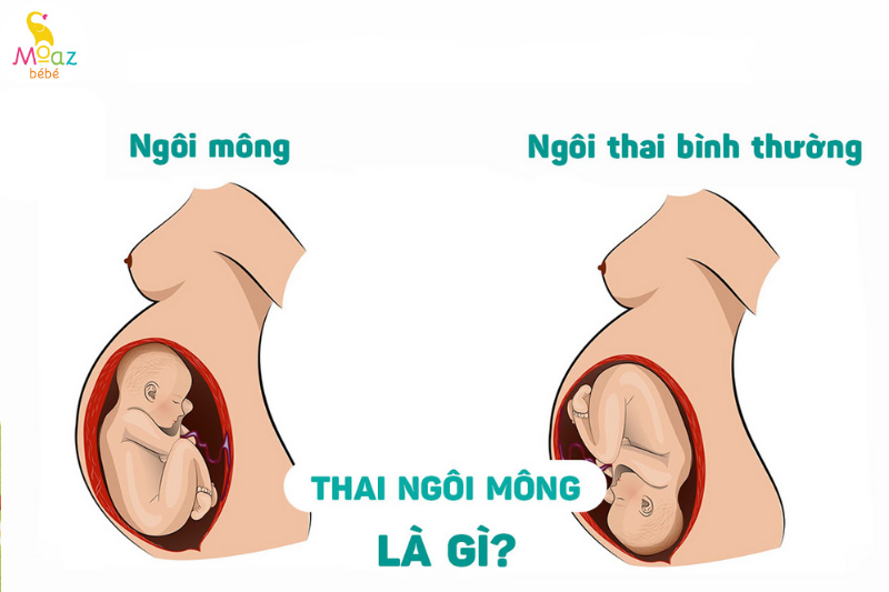 Thai ngôi mông là gì?