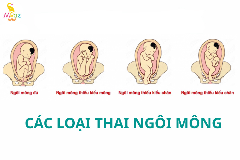 Các loại thai nhi ngôi mông