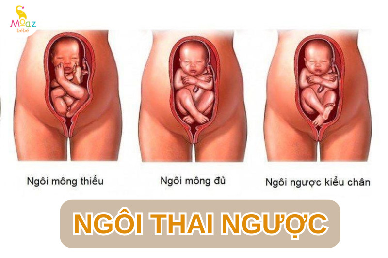 Như thế nào là ngôi thai ngược?