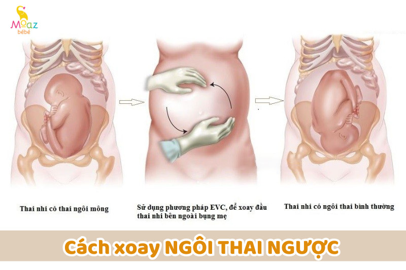 Có cách xoay ngôi thai ngược không?