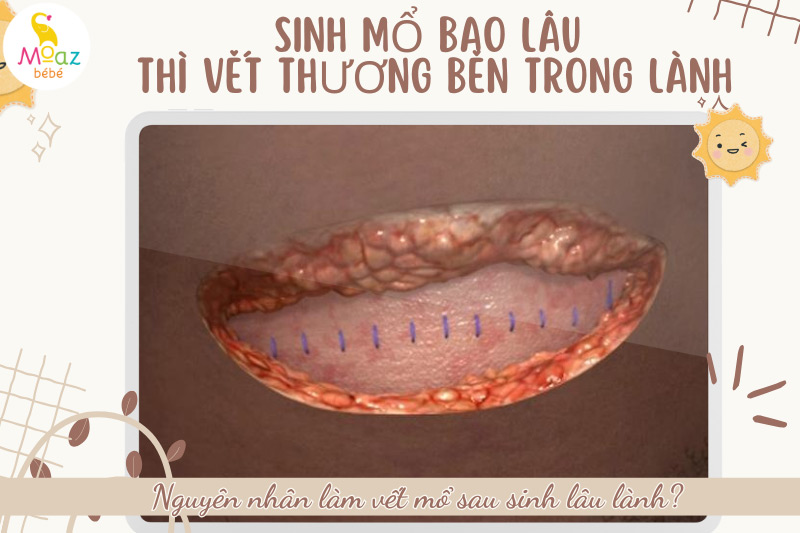 Nguyên nhân làm vết mổ sau sinh lâu lành?
