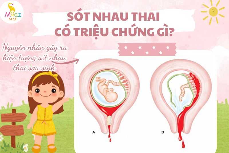 Nguyên nhân gây ra hiện tượng sót nhau thai sau sinh