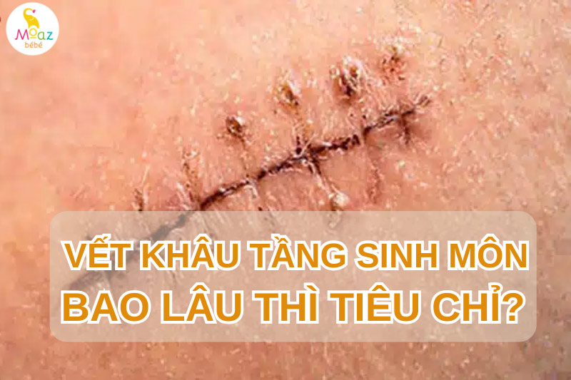 Đẻ thường khâu tầng sinh môn bao lâu thì tiêu chỉ?
