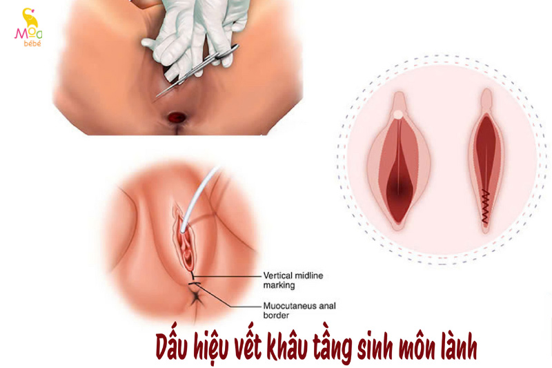 dấu hiệu vết khâu tầng sinh môn đang lành