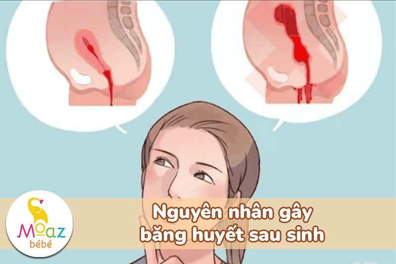 Nguyên nhân gây băng huyết sau sinh
