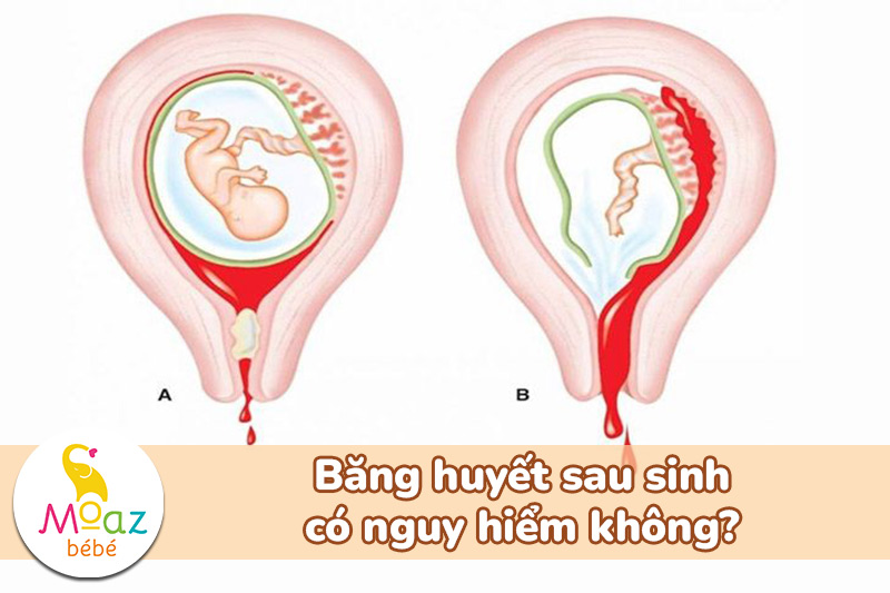 Băng huyết sau sinh có nguy hiểm không?