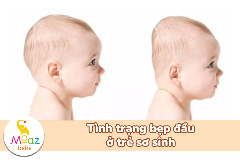 tình trạng bẹp đầu ở trẻ sơ sinh