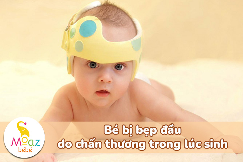 Bé bị bẹp đầu do chấn thương trong lúc sinh