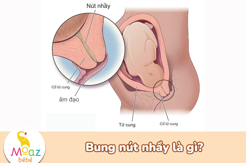 Bung nút nhầy là gì?