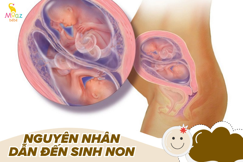 Nguyên nhân gây sinh non 