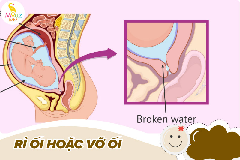 Dấu hiệu sinh non phổ biến nhất