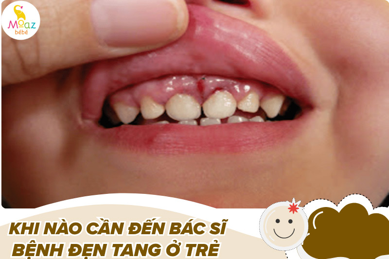Trẻ bị đẹn tang khi nào thì cần gặp bác sĩ?