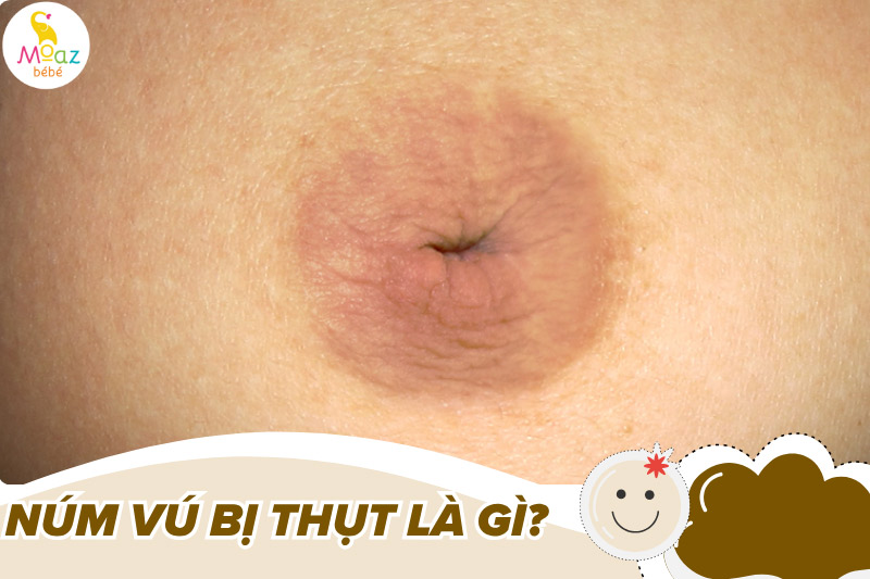 Núm vú bị thụt là như thế nào?