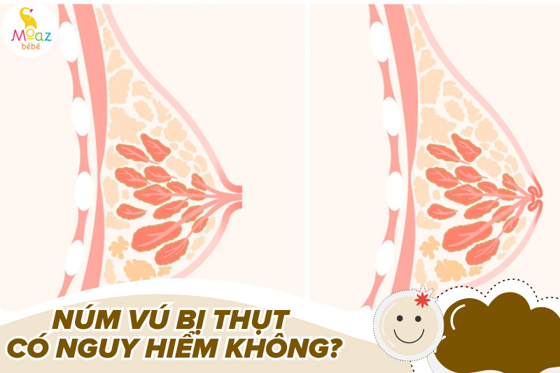 Núm vú bị thụt có nguy hiểm không?