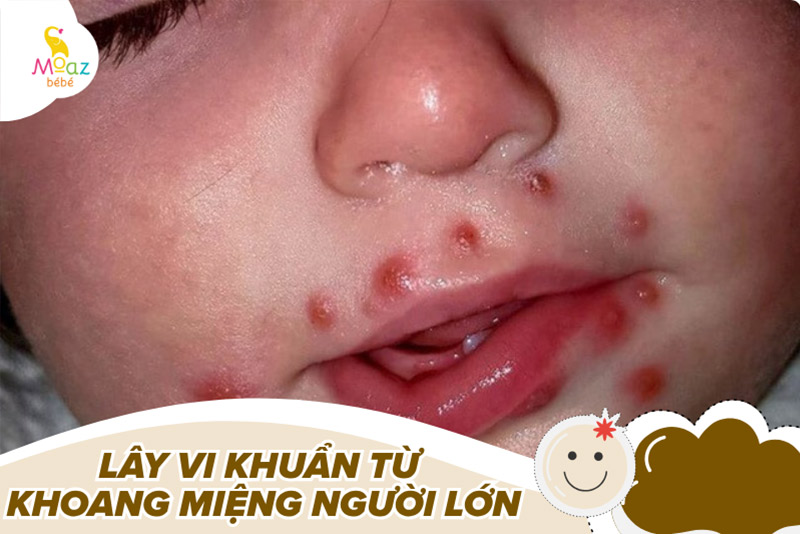 Tác hại của việc người lớn hôn trẻ sơ sinh
