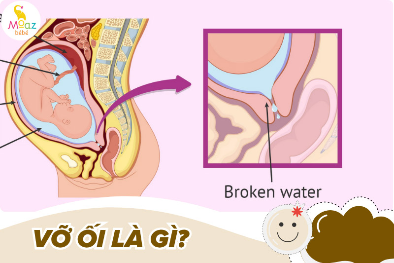 Vỡ ối là gì?