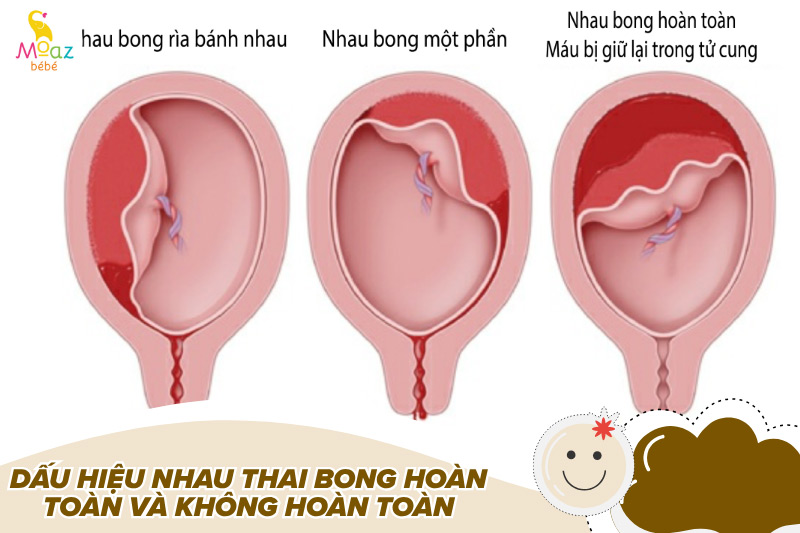 Dấu hiệu nhau thai bong hoàn toàn và không hoàn toàn