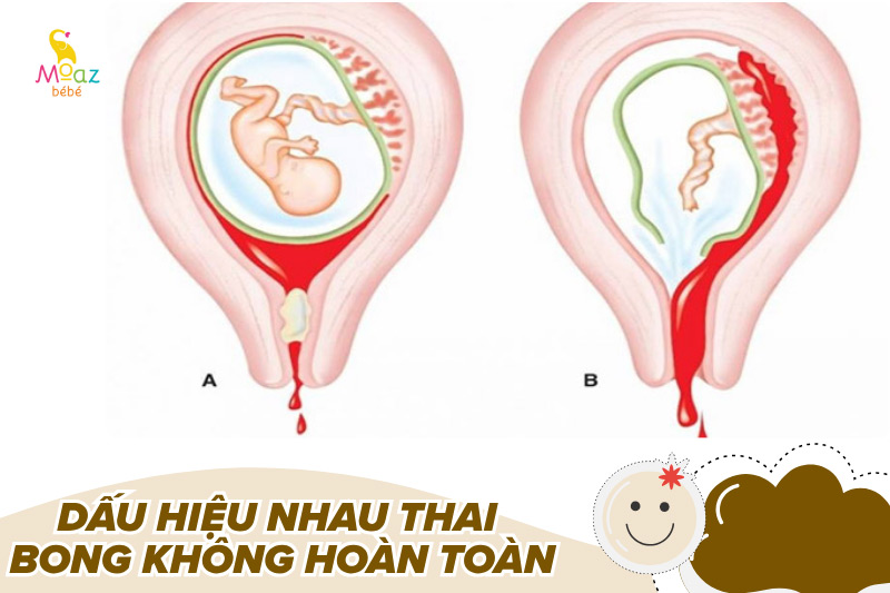 Dấu hiệu nhau thai bong không hoàn toàn