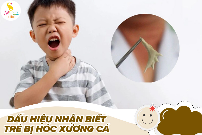 Dấu hiệu nhận biết trẻ bị hóc xương cá