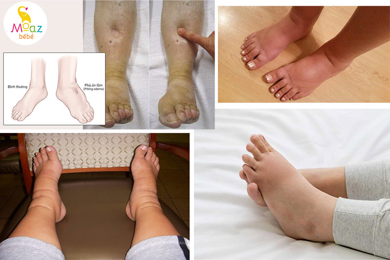 hình ảnh phù chân khi mang thai