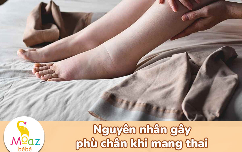 Nguyên nhân xuống máu chân khi mang thai gây phù chân